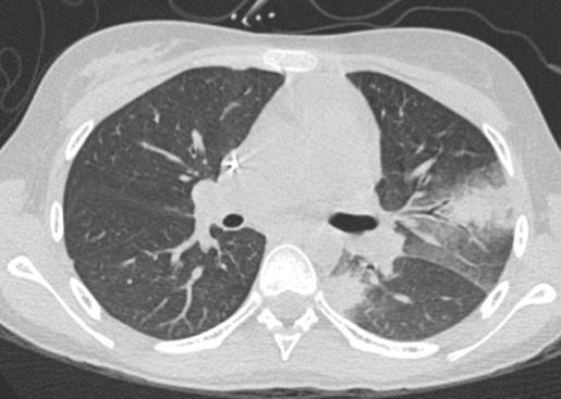 1.5-yr old boy with ALL, fever and an infiltrate in his lung Had multiple episodes of fever+neutropenia treated with broad spectrum antibiotics An implantable (Port a cath ) catheter in place Poor