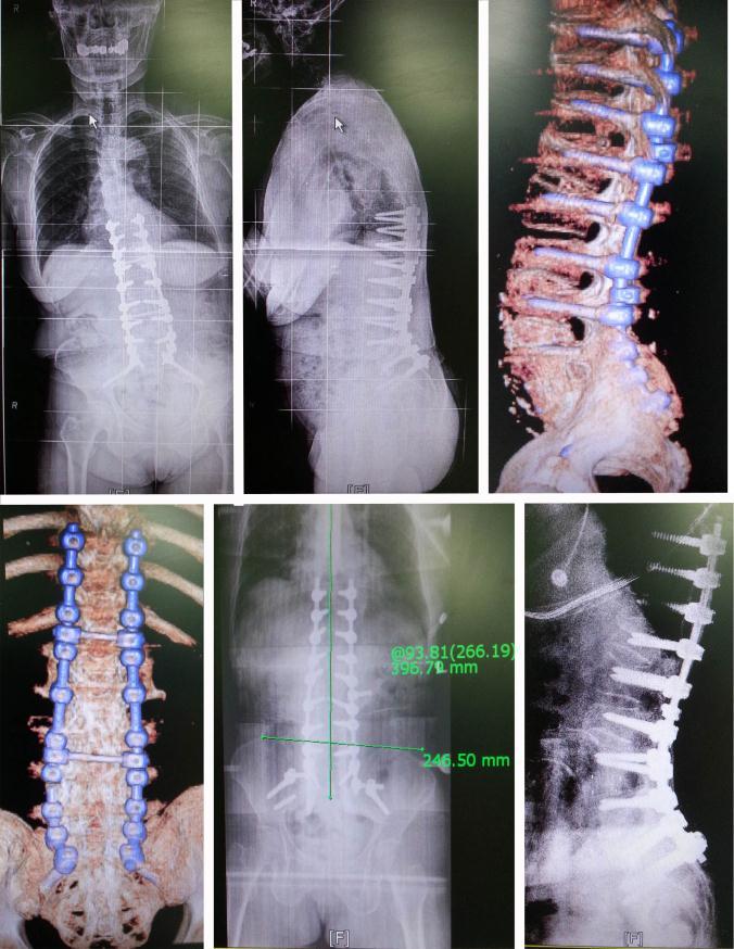 The fourth case was selective MED (L3/4) for a 71 years old patient with multilevel lumbar disc herniation and spondylolisthesis. Today, I observed an interesting case that performed by Prof LEE.