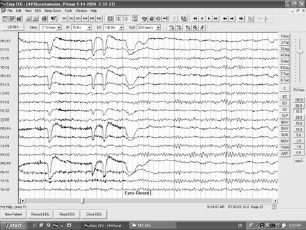 Common EEG pattern in critical care พ.ญ.