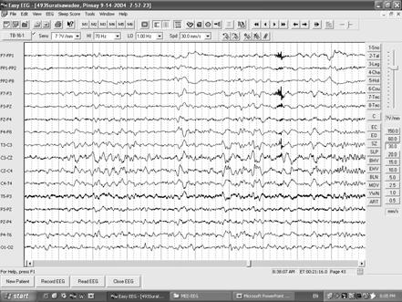 Hospital Awake Normal EEG pattern Drowsy Sleep :