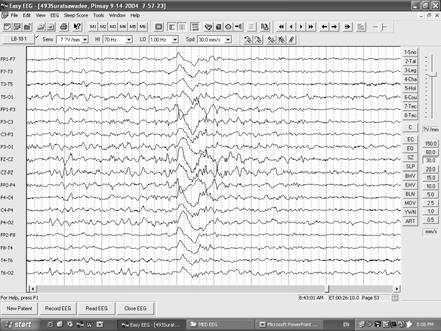 Sleep: K complexes K complexes Abnormal EEG Definition of the abnormal EEG An EEG is abnormal if it contains Epileptiform activity Slow waves Amplitude abnormalities Or Certain patterns resembling