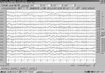 Common EEG pattern in critical care Focal slow waves Intermittent rhythmic delta activity Generalized asynchronous slow waves Excessive fast activity Amplitude abnormalities Monorhythmic activities