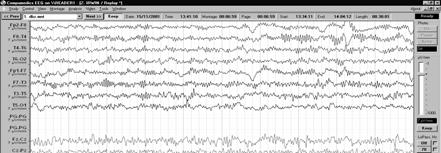 Excessive fast activity Local differences of amplitude 1.