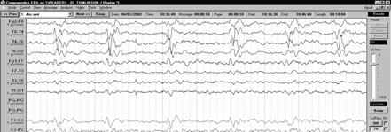 Periodic lateralizing epileptiform discharges( PLEDs)