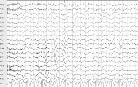 Generalized periodic epileptiform discharges (GPEDs)