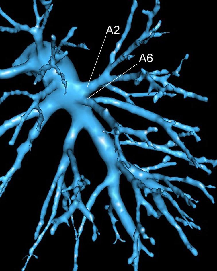 Page 2 of 6 Figure 3 Close contact between A 6 and A 9+10 (left side). Figure 1 A 6 artery, in its most common pattern, i.e., early bifurcation in 2 branches (left side).