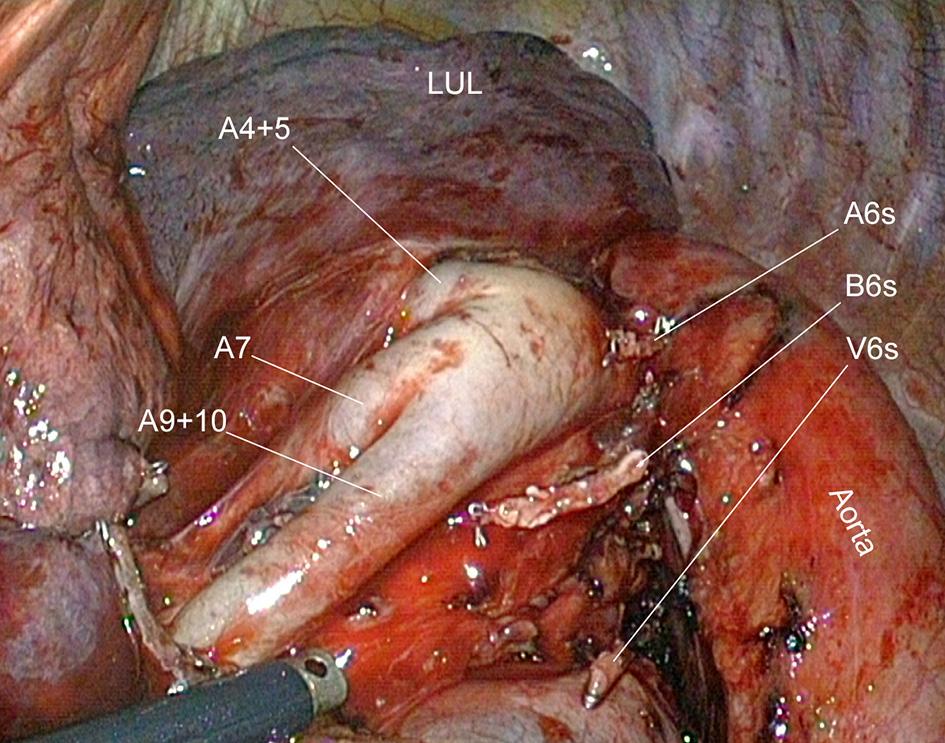 Division of the posterior portion of a thick fissure (right side) A long clamp is applied on the parenchyma, checking that the bronchial stump keeps remote and will not get stuck within the stapler