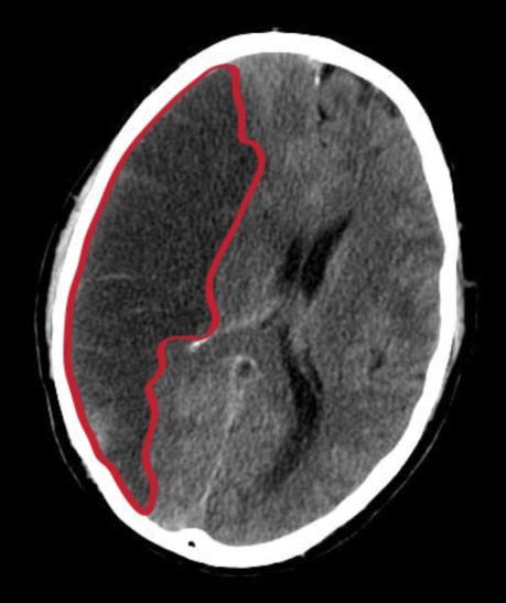 Background - Stroke Stroke sudden, non-convulsive loss of neurological function due to brain ischemia (8%) or intracranial hemorrhages (2%) Epidemiology 2-25/1 per year Disease burden 4% mortality