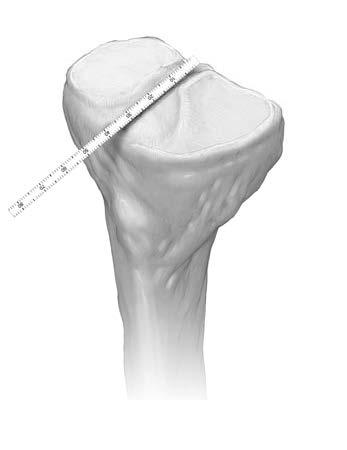 PLATEAU PREPARATION Step 3: Score a guideline on the surface of the tibia using a Bovie or 90 radiofrequency electrothermal wand (Fig. 1b).