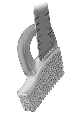 Step 14: Measure the depth of the allograft bone from the meniscal attachment sites rather than the tibial eminence. The final depth of the allograft bone bridge should be 10mm (Fig. 4a). Fig.