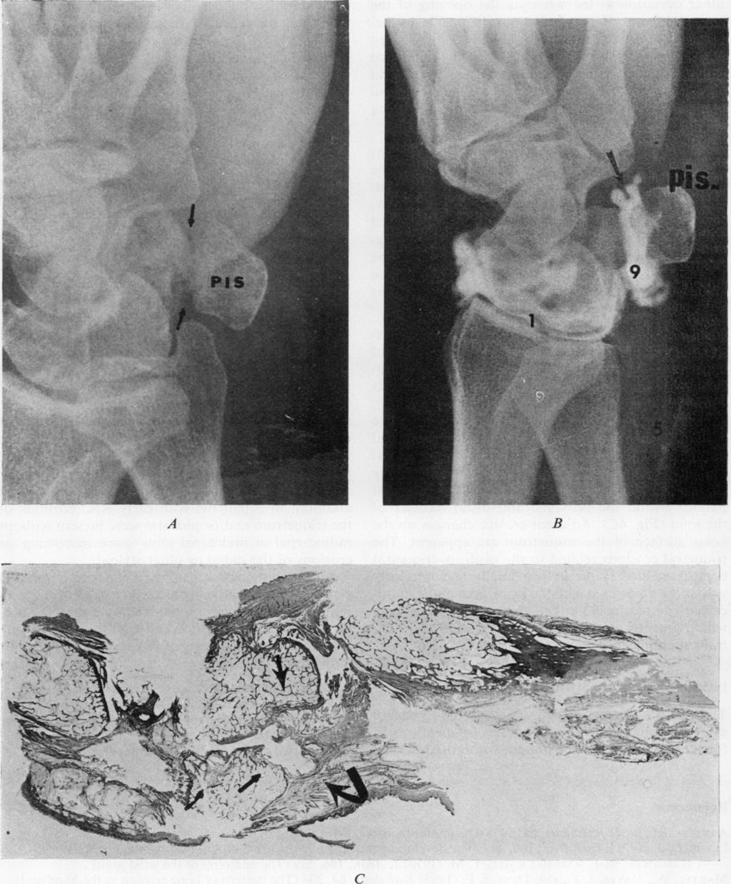A Pisiform and triquetrum in rheumatoid arthritis 49 B Ann Rheum Dis: first published as 10.1136/ard.35.1.46 on 1 February 1976. Downloaded from http://ard.bmj.com/ C FIG.