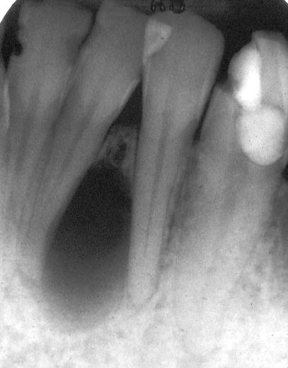 Osmotic pressure can keep expanding the cyst independent of the inflammation [C] [C] Result = Periapical