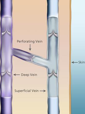Anatomy of Perforating veins Cadaveric studies 1 have shown >60 vein perforating veins from superficial to deep Normal flow is predominantly superficial to deep with primary function to drain venous
