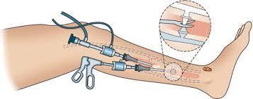 (UGFS) Subfascial endoscopic perforator