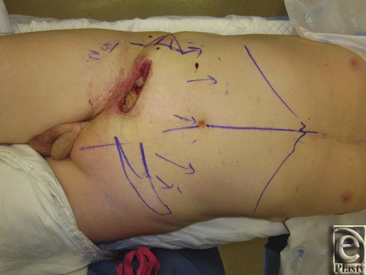 WILSON ET AL donor-site defect in the form of potential abdominal weakness or hernia in the case of the rectus abdominis flap and visible scarring/need for a skin graft in the case of an ALT flap.