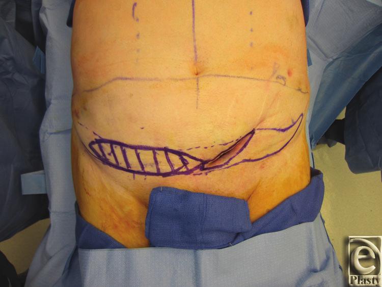 eplasty VOLUME 17 Patient 2 was a male patient who underwent excision of a left lower abdominal dedifferentiated liposarcoma and rhabdomyosarcoma of left groin and suprapubic ramus, followed by