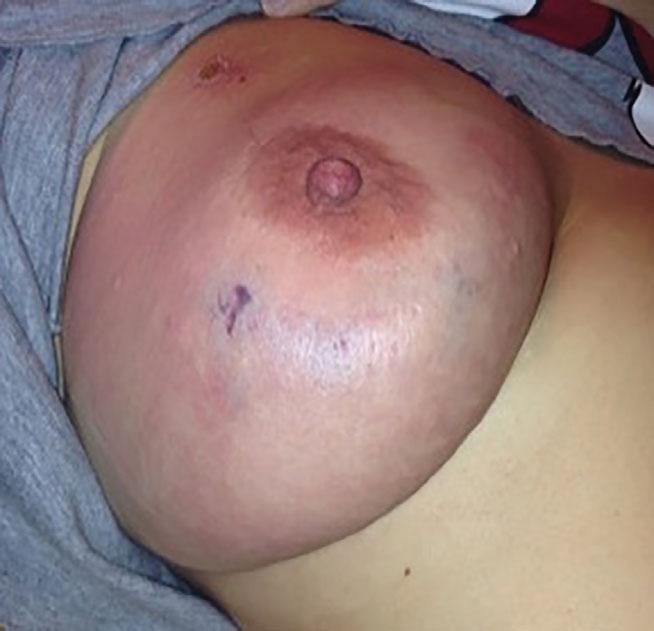 A rare case of primary necrotising fasciitis of the breast treated conservatively F. Marongiu et al.