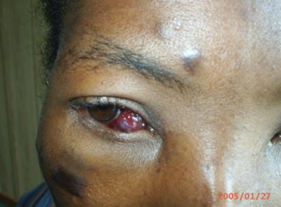 Figure 4 Picture 4: Kaposi's lesions in the eye described: classic, endemic, acquired and epidemic. Epidemic Kaposi's sarcoma is the form associated with HIV infection.