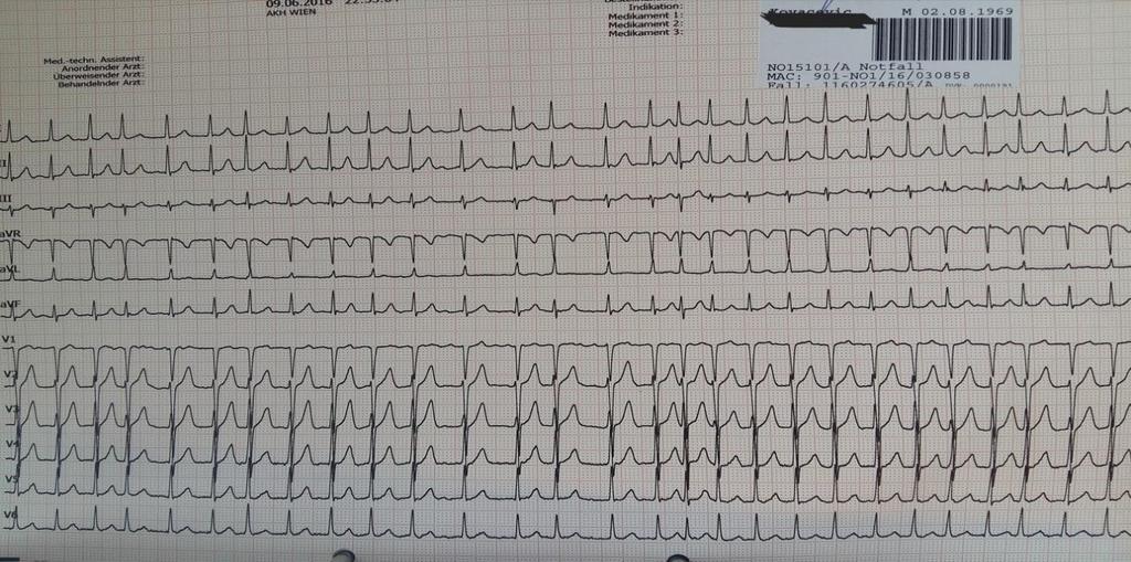 CASE REPORT Forty-seven-year-old man felt discomfort and palpitations in his chest after strenuous work (lifting heavy objects).