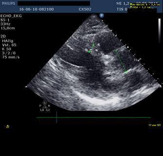 Cardiac ultrasound was done and was unremarkable (Figure 4).