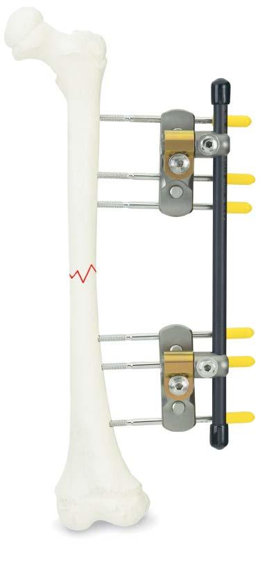 Optional Frame Configurations Rod attachment Rod attachment Frame with three Schanz screws in
