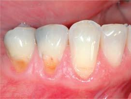 Restoring erosion lesions Patients with acidic oral environments will frequently