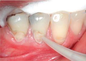 Erosion lesions Apply Cavity conditioner shade A3 is applied to the cervical