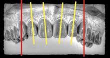 surface of the tooth determine whether the surface is convex or concave. More importantly, natural teeth do not have a 100 percent flat, or a 100 percent round, facial surface.