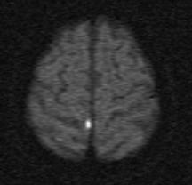 MRI confirmed TIA 77 year old woman; sudden onset sensory