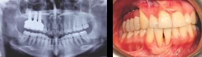 During the one-year follow-up, the tooth did not show any signs of instability with no further bone resorption.