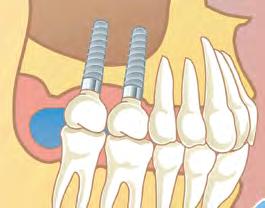 surrounding dental implants, if the existing volume of