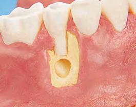 Periodontitis To preserve existing teeth that have lost