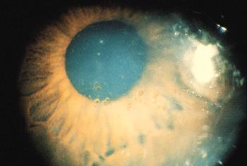 transplant Coat s white ring Etiology: corneal opacity is usually