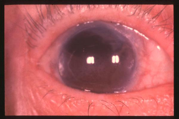 calcium salts Slit lamp: deposits located in a band shape in the interpalpebral fissure area of the