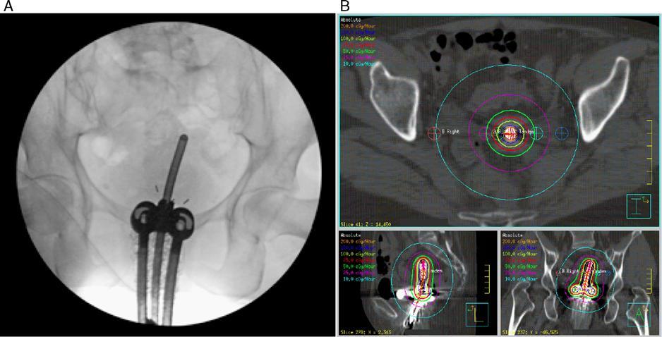 A) Intraoperative imaging at the time of first implant B) Isodose distribution with 2002 cgy delivered continuously to point A over 43.