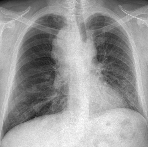 Tuberculosis and Respiratory Diseases Vol. 74. No. 5, May 2013 Case Report A 48-year-old man was referred to our hospital due to a lung mass of unknown origin.