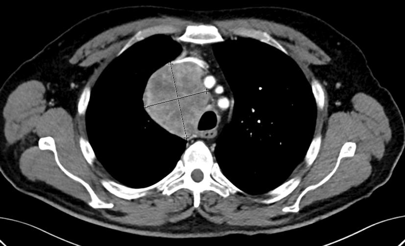 Chest X-ray (Figure 1A) showed a large mass in the right paratracheal area, causing tracheal deviation to the left with mild bronchopneumonia in the right lower lobe.
