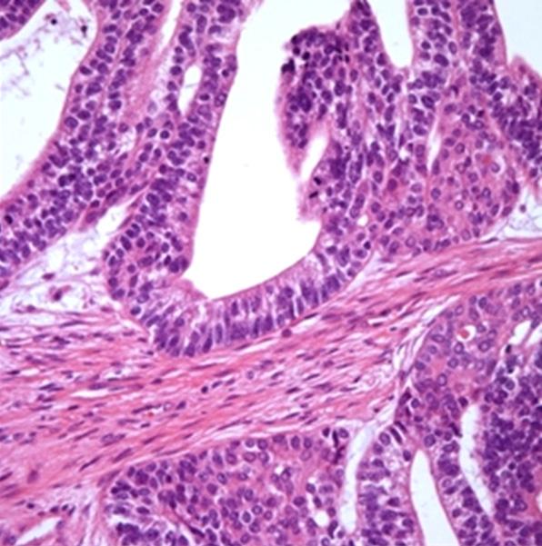 C Kyung et al: Fetal adenocarcinoma of lung treated with CCRT Figure 3.