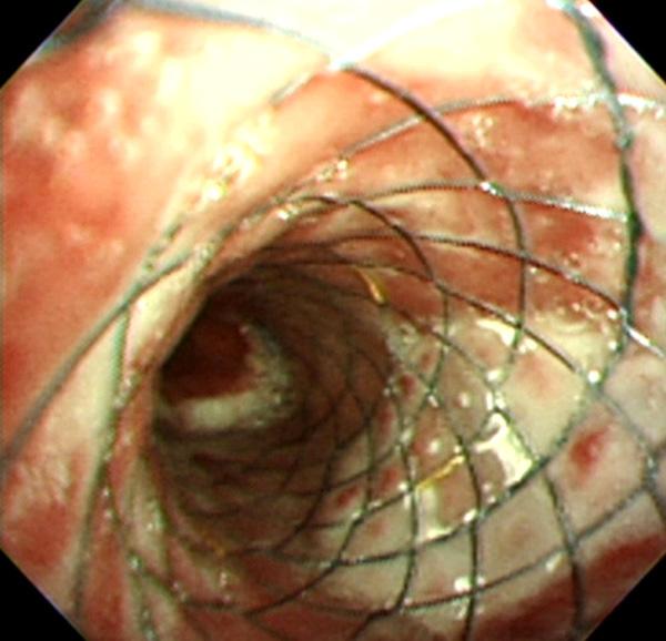 Thoracoscopic biopsy of the mediastinal lymph node was performed.