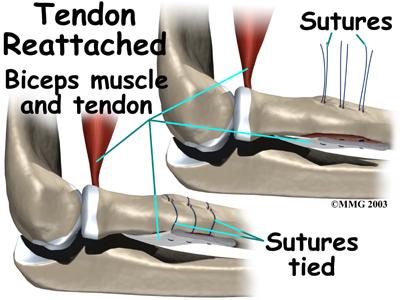 Two incision technique utilizing sutures around the radial tuberosity. The tendon may be reattached with either sutures or anchors to the radial tuberosity.