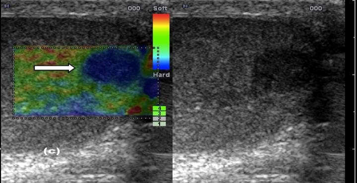 Multiparametric Ultrasound (MP-US) The addition of contrast-enhanced ultrasound (CEUS) and strain elastography (SE) to the established B-mode and colour Doppler US, facilitates testicular