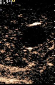 Features of testicular epidermoid cysts on contrast-enhanced sonography and real-time
