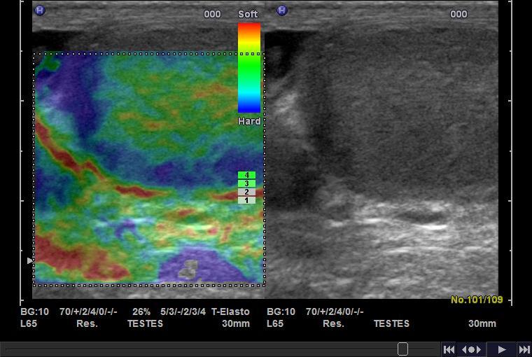 Testicular Elastography Strain Elastography of Normal Testis The blue rim on the outside of the normal
