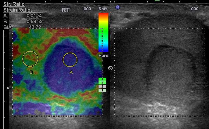 Testicular Elastography Normal Strain Elastography of Normal Testis The blue rim on the outside of the normal testis is referred to as a boundary effect.