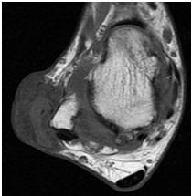 MRI MRI helps establish bone damage and erosions early in the disease Tophus: Intermediate