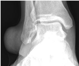 Random involvement Foot: 1 st MTP joint (MC in body) CPPD Confusing nomenclature of CPPD