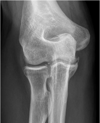 Imaging characteristic Soft tissue calcification