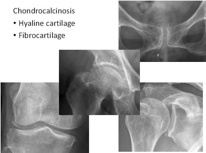Tendon, ligament and bursal calcification Pyrophosphate