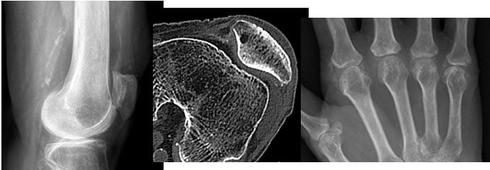 MRI of chondrocalcinosis can be confusion (high or low SI on