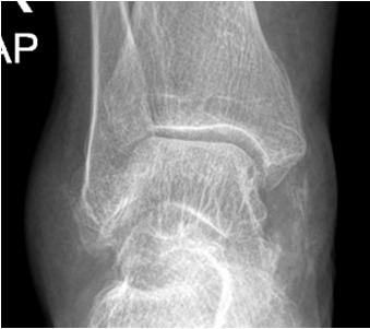 Tendon, ligament and bursal calcification